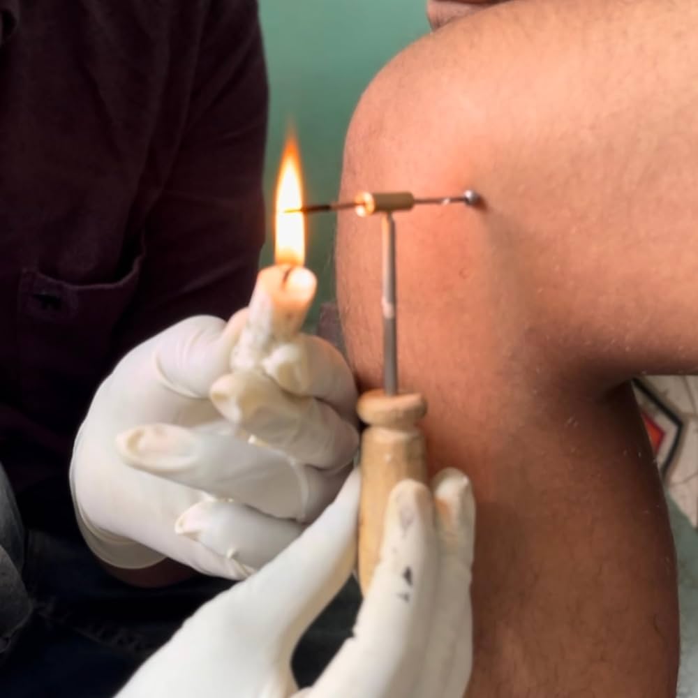 Agnikarma and Viddhakarma therapy Andheri Mumbai