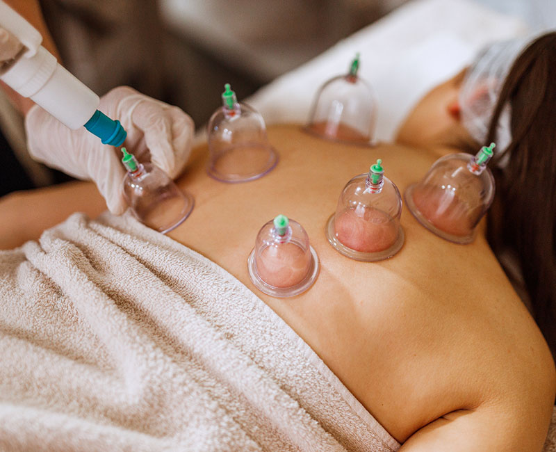 Cupping therapy Andheri Mumbai